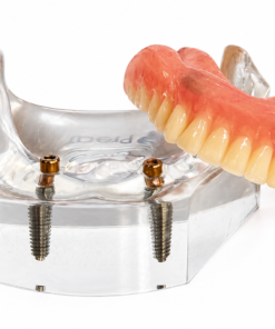 PreatLoc™ 2 Implant Patient Education Model