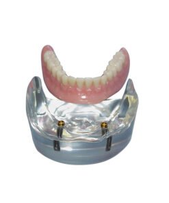 LOCATOR® Implant Model w/External Hex Implants