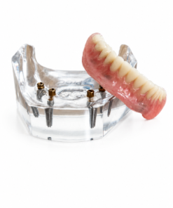 PreatLoc™ 4 Implant Patient Education Model